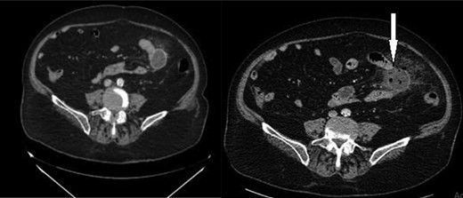 Jejunal diverticulum with surrounding inflammatory changes.