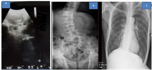 Ultrasound showing pelvic masses (A), kidney, ureter and urinary bladder X-ray showing osteoblastic lesions (B), and normal chest X-ray (C)