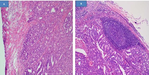 Histopathology demonstrating invasive prostatic adenocarcinoma, hematoxylin and eosin staining x40 (A), and a lymph node infiltrated by prostatic adenocarcinoma, hematoxylin and eosin staining x100, (B)
