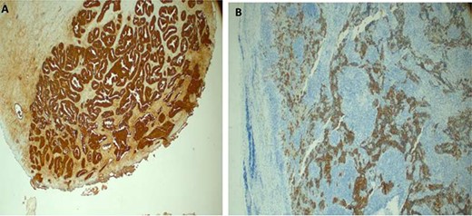 Immunostaining of the supraclavicular lymph node with (PSA highlighting tumor cell positivity, immunohistochemstiry (IHC) x40 in prostate biopsy (A) and supraclavicular lymph node, IHC x20 (B)