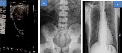 Ultrasound of left neck showing supraclavicular mass (A), kidney, ureter and urinary bladder X-ray showing extensive osteoblastic lesions (B) and normal chest X-ray (C)