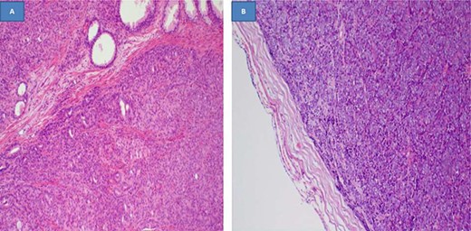 Histopathology of the prostate tissue showing invasive adenocarcinoma, hematoxylin and eosin staining x100 (A), and a lymph node with complete effacement and replaced by a solid tumor, hematoxylin and eosin staining x100 (B)