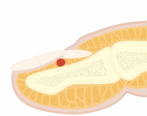 Diagrammatic representation of glomus tumour.