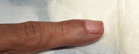 Pre-operative clinical photograph demonstrating violaceous hue of the nail plate.
