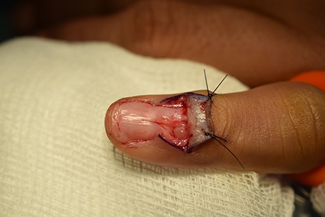 Intra-operative photograph demonstrating a well circumscribed lesion of the glomus body.
