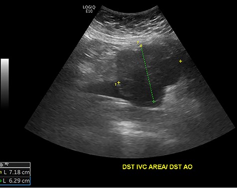Initial ultrasound showing a large heterogenous, hypoechoic mass like lesion overlying the IVC.