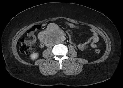 Abdominal CT scan demonstrating IVC lesion that partially encircles the aorta.