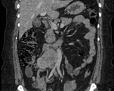 Abdominal CT demonstrating the length and location of the IVC in relation to the aorta.