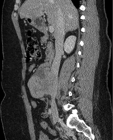 Abdominal CT demonstrating the location of the tumor in the IVC.