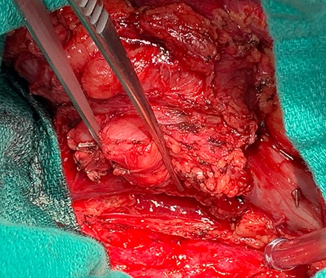 Dissection of primary tumor away abdominal aorta pictured in the lower aspect of the image.