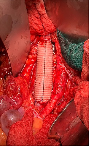 End to end Dacron graft placement.