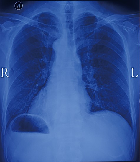 Chest X-ray showing dextrocardia