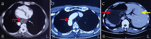Contrast-enhanced CT of the chest and upper abdomen showing (a) the abnormally thickened esophageal wall of the thoracic middle-lower segment (red arrow); (b) the aortic arch as arranged in SIT (red arrow); and (c) the liver (yellow arrow), stomach (red arrow), and spleen (blue arrow) as arranged in SIT