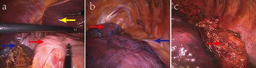 Intraoperative observation demonstrating (a) the stomach (red arrow) in the right hypochondriac region, the spleen (blue arrow) on the right rear of the stomach, and the liver (yellow arrow) on the left; (b) the azygos vein (blue arrow) and the three lobes (red arrow) in the left thoracic cavity; and (c) the esophageal carcinoma (red arrow)