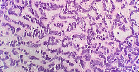 Microscopic examination reveals that tumor composed of luminal/ductal epithelial cells with variable glandular pattern and pseudolumens containing eosinophilic basement membrane material (HE x40).