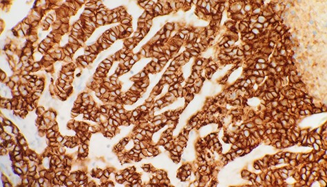 Immunohistochemical stain reveals that tumor cells are positive for E-Cadherin (IHC x40).