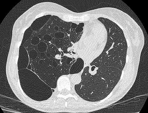 CT scan demonstrating heterogeneous bullous emphysema with hyperinflation of the right lung and mediastinal shift.