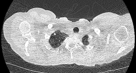 CT scan demonstrating small nodule in the right upper zone.