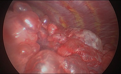 Intra-operative appearances of the right lower lobe demonstrating multiple bullae and parenchymal destruction.
