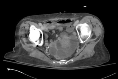 Axial slice of the CT of the abdomen/pelvis demonstrating distended fluid-filled loops of small bowel mostly within the pelvis. There was evidence of some bowel wall thickening and perienteric fat stranding.