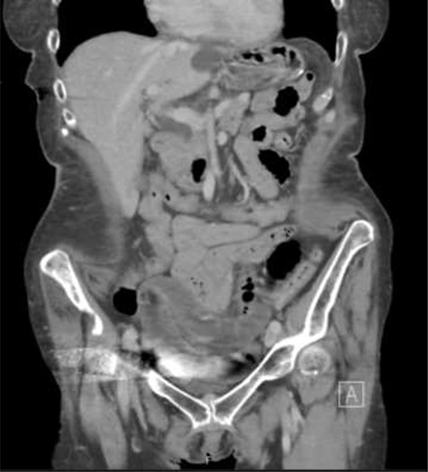Coronal slice of the CT of the abdomen/pelvis demonstrating distended fluid-filled loops of small bowel mostly within the pelvis. The transition point was identified in the pelvis.