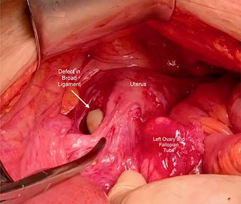 Intraoperative photograph of a defect within left side of broad ligament. The left ovary and fallopian tube have been reflected medially.