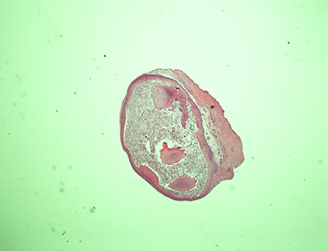Epidermal cyst—20× magnification. Low power microscopic view of the vocal cord epidermal inclusion cyst. Hematoxylin and eosin (H&E) stain X.
