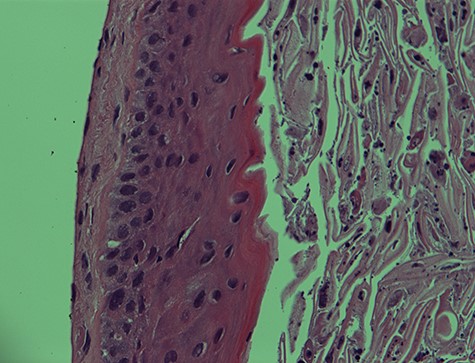 I. Epidermal cyst—400× magnification. EIC of the vocal cord. Note the undulating lining squamous epithelium with numerous keratinous and cellular debris in the lumen. H&E stain X400.