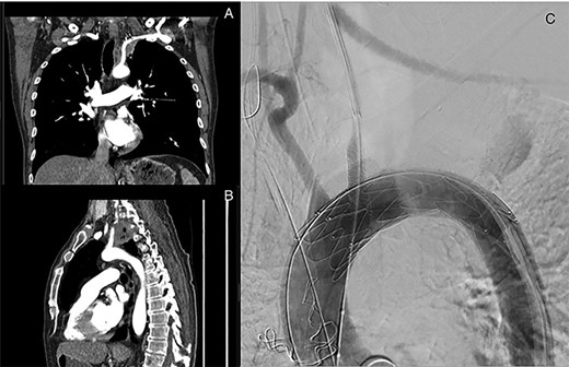 Left superior sulcus tumour encasing the left subclavian artery requiring a left common carotid to subclavian artery bypass and TEVAR placement using in situ fenestration for the left common carotid artery to facilitate resection of the tumour.