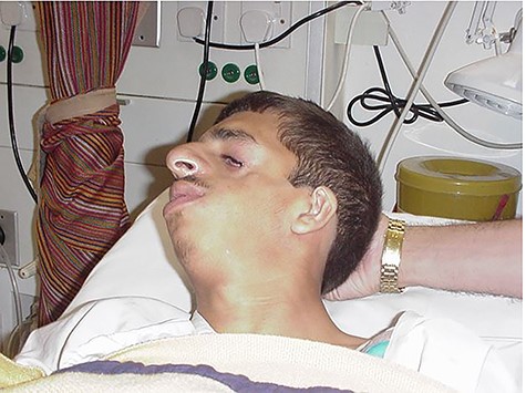 Picture showing features of Treacher Collins syndrome.