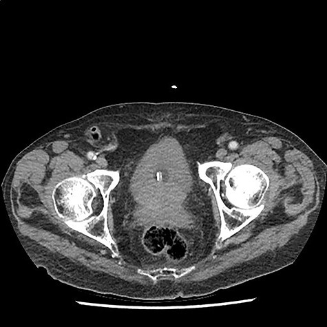 Axial CT scan demonstrating right-sided inguinal hernia with vermiform appendix located within it, suggestive of Amyand’s hernia.