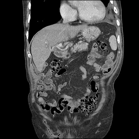 Coronal CT scan demonstrating appendicitis located within the inguinal canal.