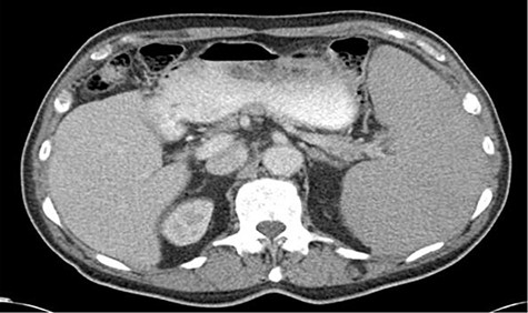 CT abdomen and pelvis axial images demonstrating splenomegaly measuring 18.4 × 9.4 × 15.8 cm.