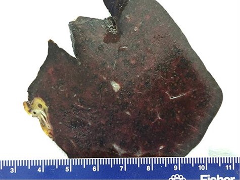 Gross formalin-fixed pathological specimen fragment with deeply pigmented melanocytes.