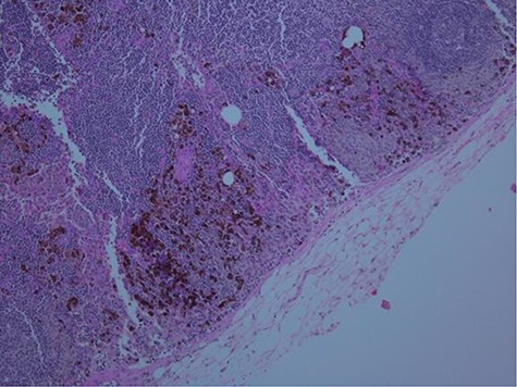 Low power H and E stained slide with pigmented melanoma cells.