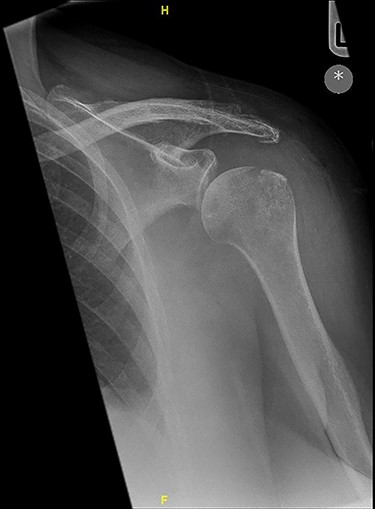 X-ray imaging showed degenerative changes in the glenohumeral and acromioclavicular articulations.