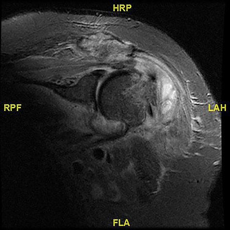 MR.COR STIR LEFT. Se 3. MRI showing degenerative changes.