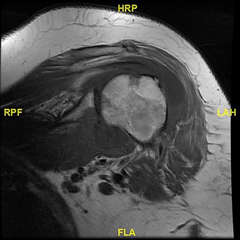 MR.COR T1 LEFT. Se 3. MRI imaging showed degenerative changes.