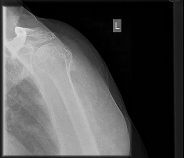 Two months post-surgery.