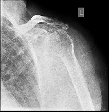 Six months post-surgery—profound loss of joint space and superior subluxation.