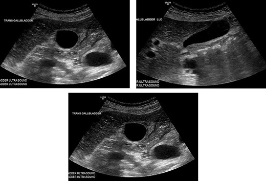 These are from the patient’s ultrasound in the ER. The gall bladder wall was measured at 4.5 mm, and a small amount of pericholecystic fluid was present. There were no gallstones and the common bile duct was within normal caliber.