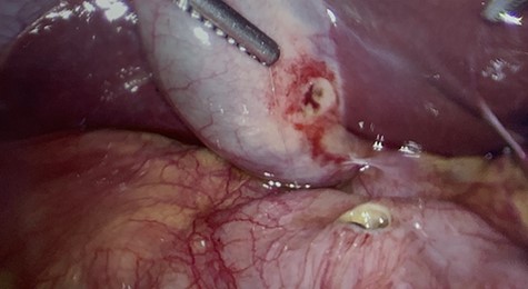 Complete view of the both the gallbladder and duodenum.