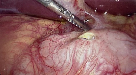 First portion of duodenum with perforated ulcer. Gallbladder retracted out of frame.