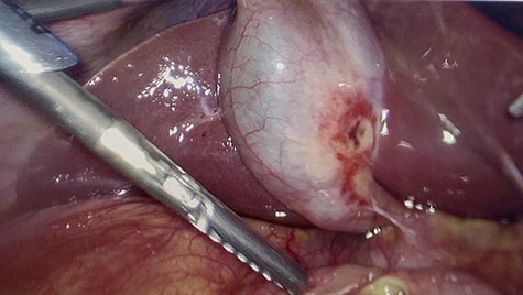 The gallbladder had been gently resected from the duodenum revealing a nonperforated ulceration where it had been patching the duodenal ulcer.