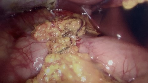 Image of completed laparoscopic graham patch over the duodenal perforation.