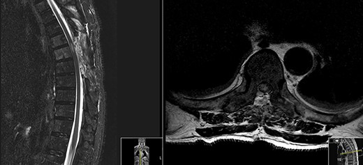 Postoperative MRI (sagittal and axial contrasted T2).