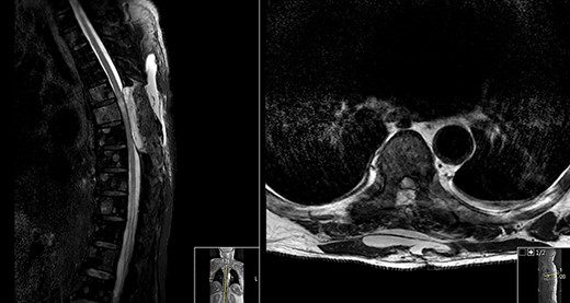 Day 14 post-op MRI (sagittal and axial contrasted T2).