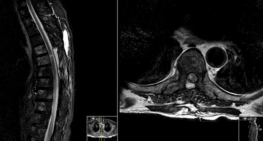 Day 90 post-op MRI (sagittal and axial contrasted T2).
