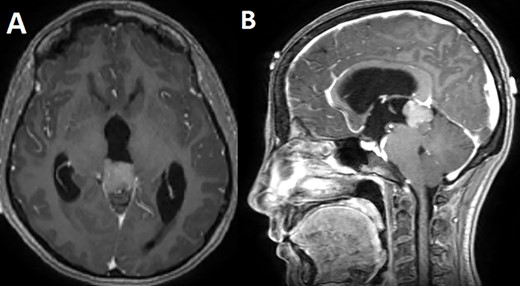 T1 enhanced axial (A) and sagittal (B) MRI showing a T1 hypointense homogenously enhancing pineal tumor.