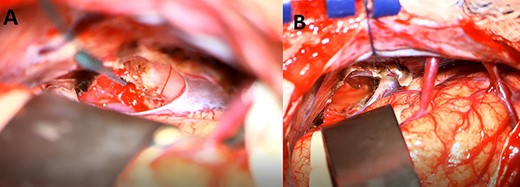 An intraoperative image under microscopic magnification showing the pineal tumor during the initial exposure (A) and the surgical cavity at the end of the gross total resection (B).
